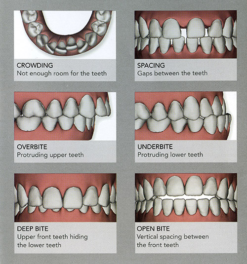 invisalign benefits straighter hygienic teeth